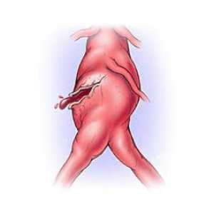 Aortalni rupture: uzroci, simptomi, kako bi se izbjegla smrt, operacije, prognoza