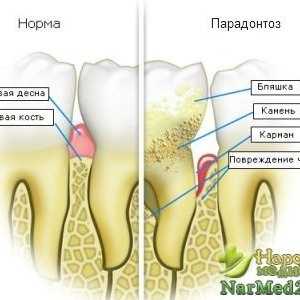 Recepti biste dobili osloboditi od parodontne bolesti na osnovi narodnih lijekova