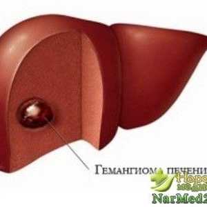 Preporučene metode pomoć osobama s hemangioma jetre