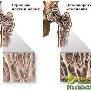 Sadržanu u narodnoj medicini u liječenju osteoporoze