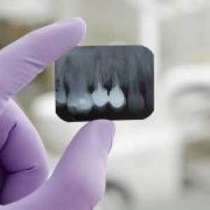 Rendgenski zubi: vrste i dešifriranje