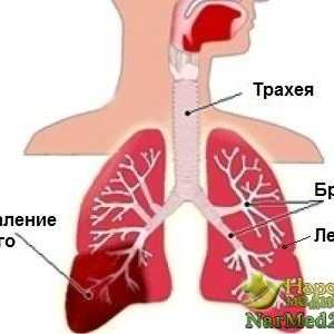 Rizik od upale pluća u odraslih i djece