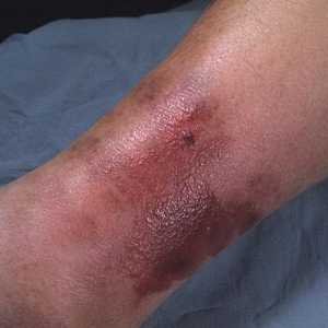 Erizipele noge: Simptomi i liječenje