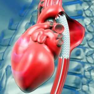 Srce aneurizme: uzroci, simptomi, kako se postupa