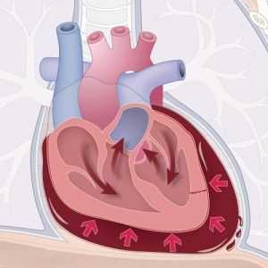 Tamponada srca: simptomi, dijagnoza, prva pomoć, liječenje