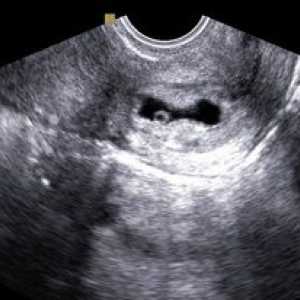 Cervikalna trudnoća