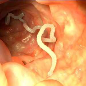 Simptomatologija i liječenje crva