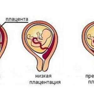 Simptomi i dijagnoza niska placentacije