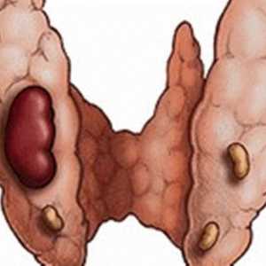 Simptomi i liječenje adenoma štitne