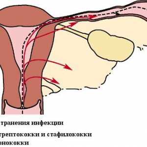 Simptomi i tretman adneksitisa kod žena