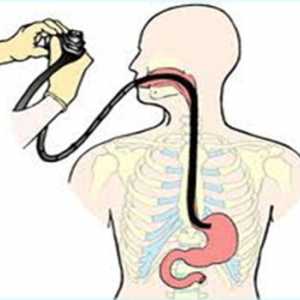 Simptomi i liječenje kronične gastroduodenitis
