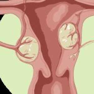 Simptomi i liječenje intersticijske subserous maternice mioma