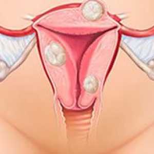 Simptomi mioma maternice prema lokaciji