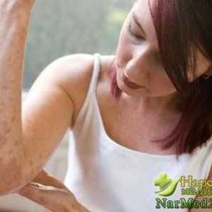 Savjeti za liječenje atopijskog dermatitisa kod kuće