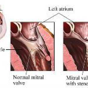 Mitralna stenoza