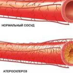 Constrictive ateroskleroze