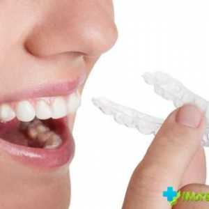 Troškovi kape uskladiti zube: Opis, vrste i kategorije cijena