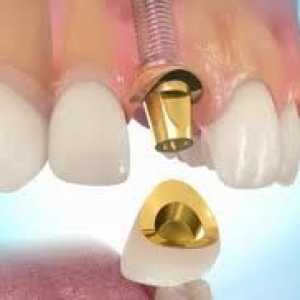 Trošak dentalnih implantata, te njihovi stavovi i gledišta