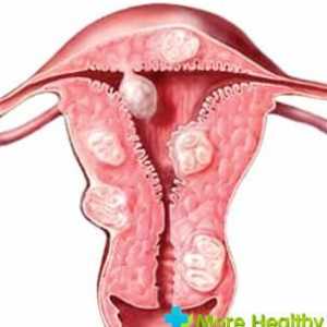 Trebam li imati pobačaj za mioma maternice?