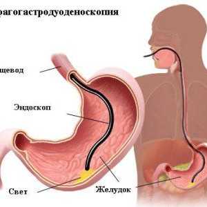 Postupak gastroskopija želudac