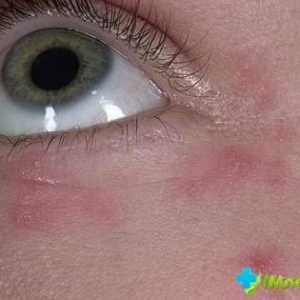 Osip oko očiju - njegovim uzrocima i liječenju