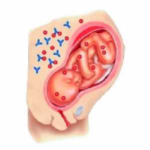 Hemolitička bolest novorođenčeta (HDN): uzroci, simptomi, kako se postupa