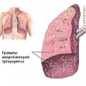 Plućna tuberkuloza