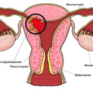 Ginekolog Savjet: kada raditi ultrazvuk za endometriozu