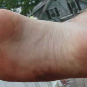 Što je rizik od stopala flegmona