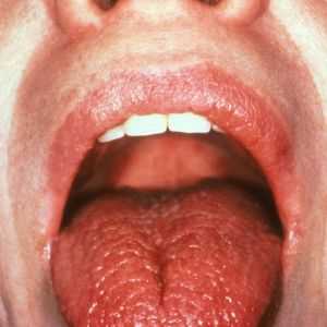 Što je uzrok trnci jezik?