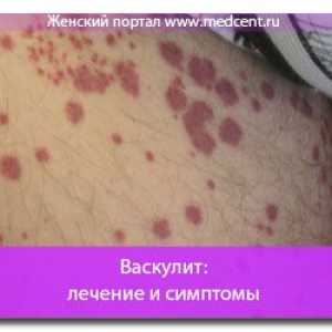 Vaskulitis: Liječenje i simptomi