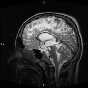Unutarnja hidrocefalus mozak