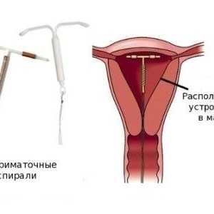 Intrauterini ulošci za kontracepciju: što je bolje?
