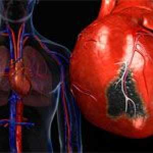Mogući simptomi infarkta miokarda
