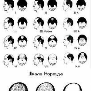 Gubitak kose (alopecia areata)