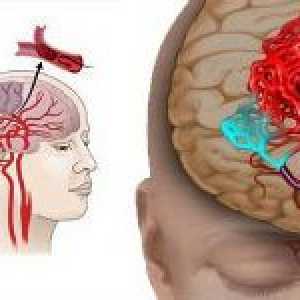 Bolest mozga vaskularnoj porijekla