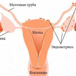 Zašto se dodjeljuje na fizikalnu terapiju endometrioze